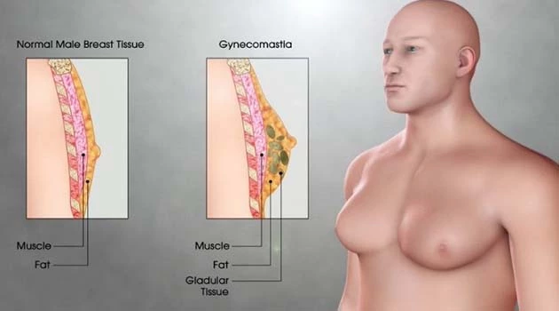 What is Gynecomastia Its Symptoms And Treatment In 2022
